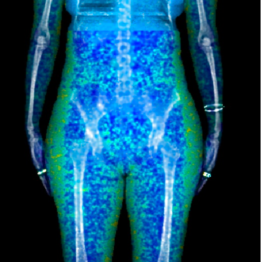 Body composition dexa scan showing distribution of fat 